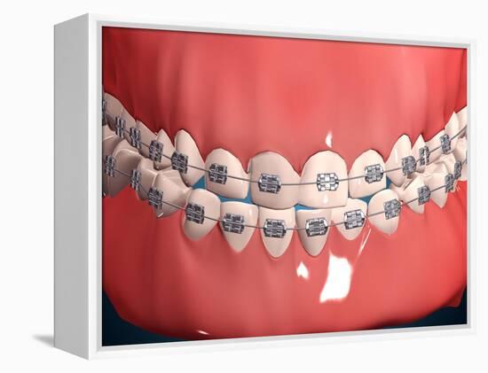 Medical Illustration of Human Mouth Showing Teeth, Gums and Metal Braces-null-Framed Stretched Canvas