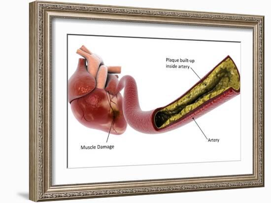 Medical illustration of plaque build-up in the artery, leading to a heart attack.-Stocktrek Images-Framed Art Print