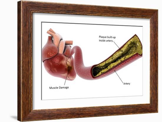 Medical illustration of plaque build-up in the artery, leading to a heart attack.-Stocktrek Images-Framed Art Print