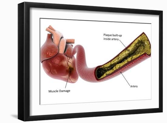 Medical illustration of plaque build-up in the artery, leading to a heart attack.-Stocktrek Images-Framed Art Print