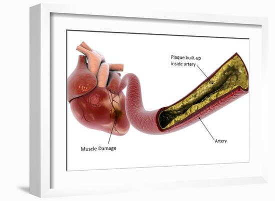 Medical illustration of plaque build-up in the artery, leading to a heart attack.-Stocktrek Images-Framed Art Print