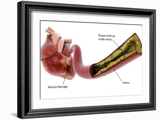 Medical illustration of plaque build-up in the artery, leading to a heart attack.-Stocktrek Images-Framed Art Print