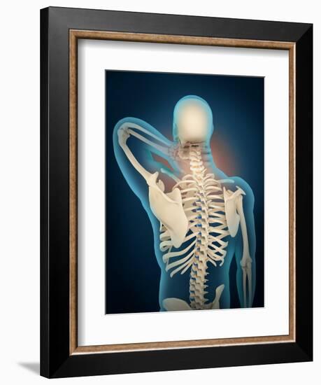 Medical Illustration Showing Inflammation in Human Neck Are-null-Framed Art Print