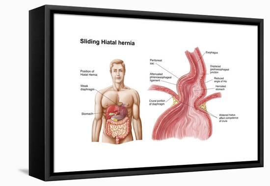 Medical Ilustration of a Hiatal Hernia in the Upper Part of the Stomach into the Thorax-null-Framed Stretched Canvas