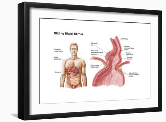 Medical Ilustration of a Hiatal Hernia in the Upper Part of the Stomach into the Thorax-null-Framed Art Print