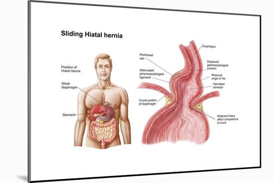 Medical Ilustration of a Hiatal Hernia in the Upper Part of the Stomach into the Thorax-null-Mounted Art Print