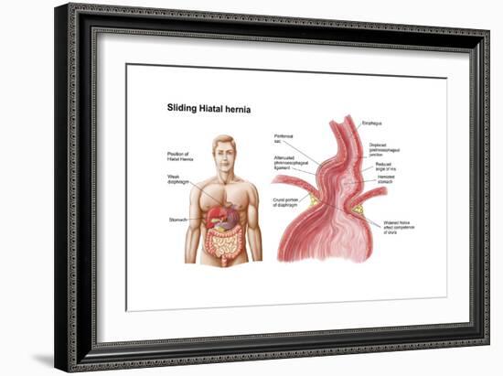 Medical Ilustration of a Hiatal Hernia in the Upper Part of the Stomach into the Thorax-null-Framed Art Print