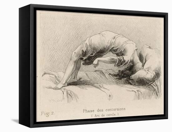 Mental Patient at la Salpetriere Going Through the Phase of Contortions-P. Richer-Framed Premier Image Canvas