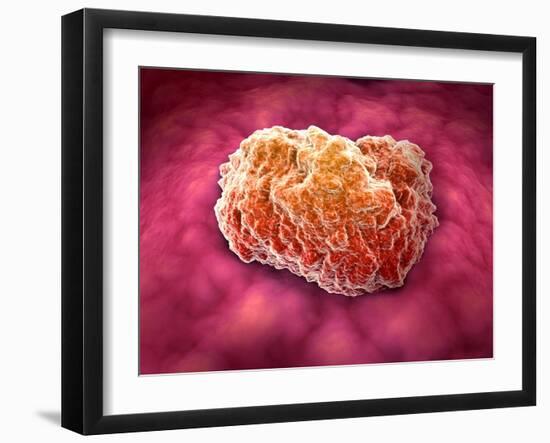 Microscopic View of Tumor-null-Framed Art Print