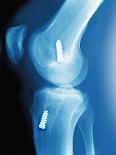 Anterior Cruciate Ligament Repair, X-ray-Miriam Maslo-Photographic Print