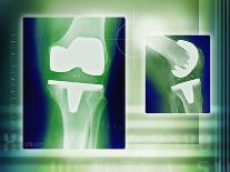 Knee Replacement, X-rays-Miriam Maslo-Photographic Print