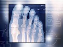 Anterior Cruciate Ligament Repair, X-ray-Miriam Maslo-Framed Photographic Print