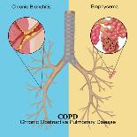 Chronic Obstructive Pulmonary Disease (COPD)-Monica Schroeder-Giclee Print