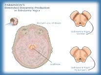 Substantia Nigra & Parkinson's Disease-Monica Schroeder-Giclee Print