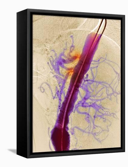 Narrowed Arteries, X-ray-Du Cane Medical-Framed Premier Image Canvas