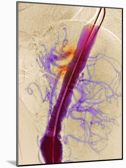 Narrowed Arteries, X-ray-Du Cane Medical-Mounted Photographic Print