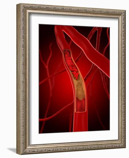 Narrowed Artery, Artwork-SCIEPRO-Framed Photographic Print