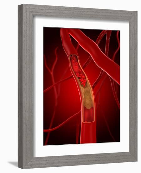 Narrowed Artery, Artwork-SCIEPRO-Framed Photographic Print