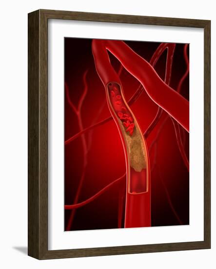 Narrowed Artery, Artwork-SCIEPRO-Framed Photographic Print