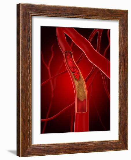 Narrowed Artery, Artwork-SCIEPRO-Framed Photographic Print