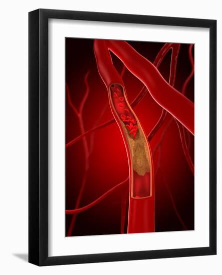 Narrowed Artery, Artwork-SCIEPRO-Framed Photographic Print