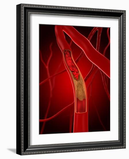 Narrowed Artery, Artwork-SCIEPRO-Framed Photographic Print