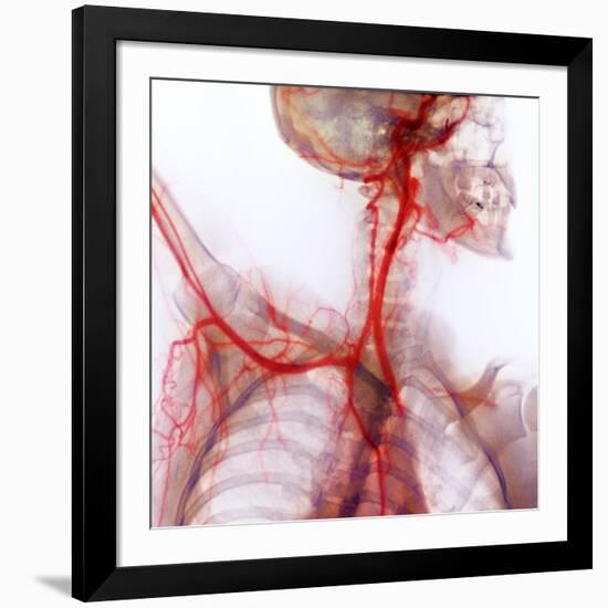 Neck And Shoulder Arteries, X-ray-null-Framed Photographic Print