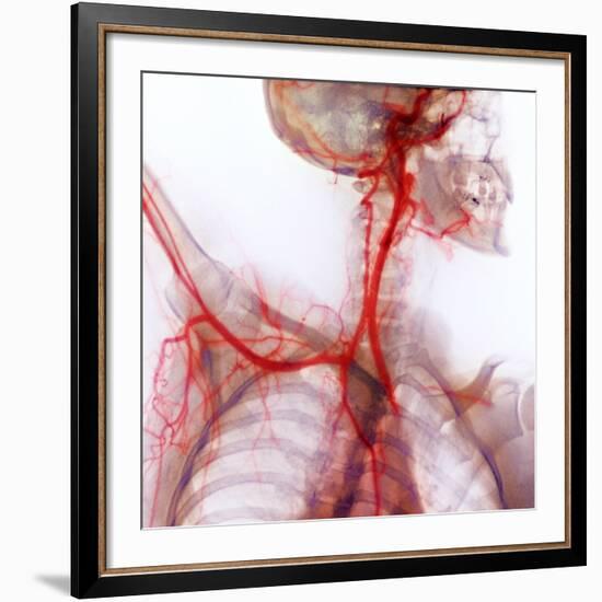 Neck And Shoulder Arteries, X-ray-null-Framed Photographic Print