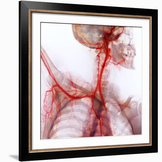 Neck And Shoulder Arteries, X-ray-null-Framed Photographic Print