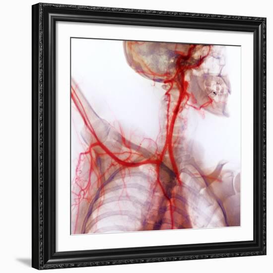 Neck And Shoulder Arteries, X-ray-null-Framed Photographic Print