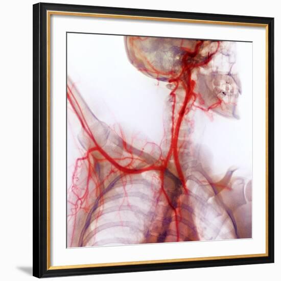 Neck And Shoulder Arteries, X-ray-null-Framed Photographic Print