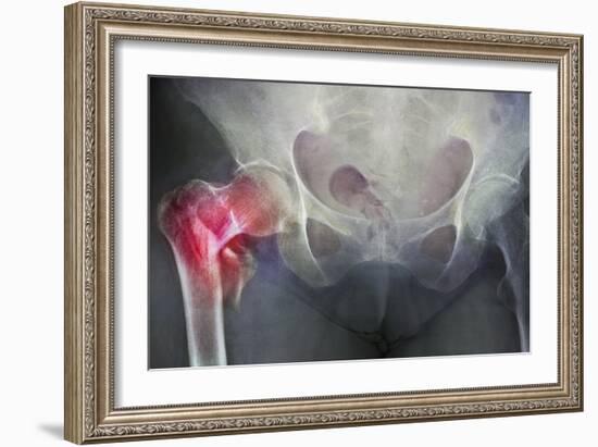 Neck of Femur Fracture, X-ray'-Du Cane Medical-Framed Photographic Print