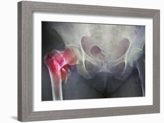 Neck of Femur Fracture, X-ray'-Du Cane Medical-Framed Photographic Print