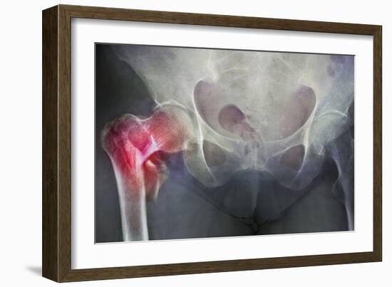 Neck of Femur Fracture, X-ray'-Du Cane Medical-Framed Photographic Print