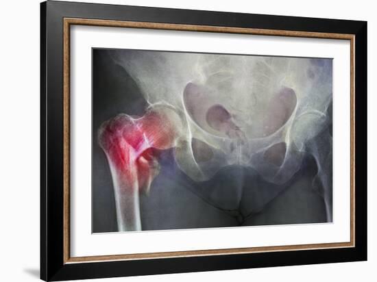 Neck of Femur Fracture, X-ray'-Du Cane Medical-Framed Photographic Print