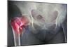 Neck of Femur Fracture, X-ray'-Du Cane Medical-Mounted Photographic Print