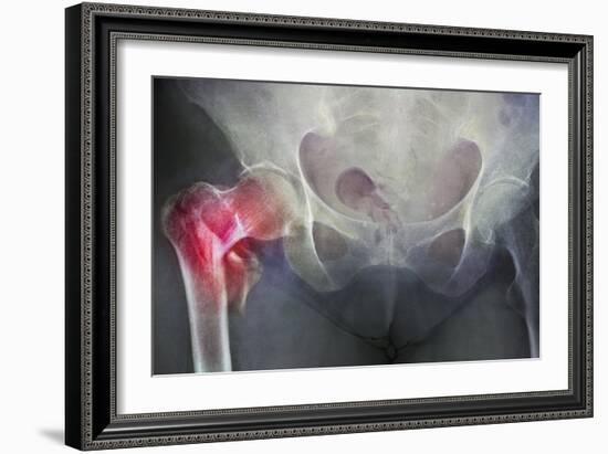Neck of Femur Fracture, X-ray'-Du Cane Medical-Framed Photographic Print