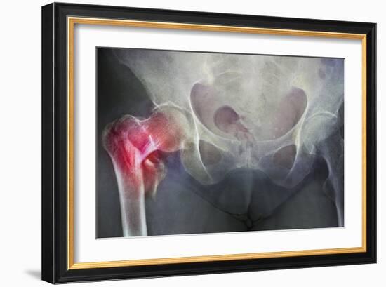 Neck of Femur Fracture, X-ray'-Du Cane Medical-Framed Photographic Print