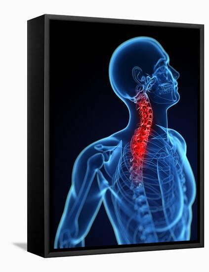 Neck Pain, Conceptual Artwork-SCIEPRO-Framed Premier Image Canvas