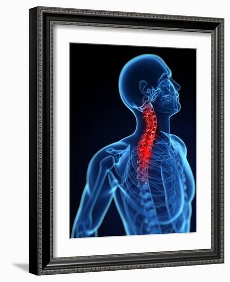 Neck Pain, Conceptual Artwork-SCIEPRO-Framed Photographic Print