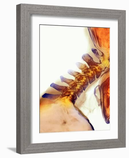 Neck Vertebrae Extended, X-ray-Science Photo Library-Framed Photographic Print