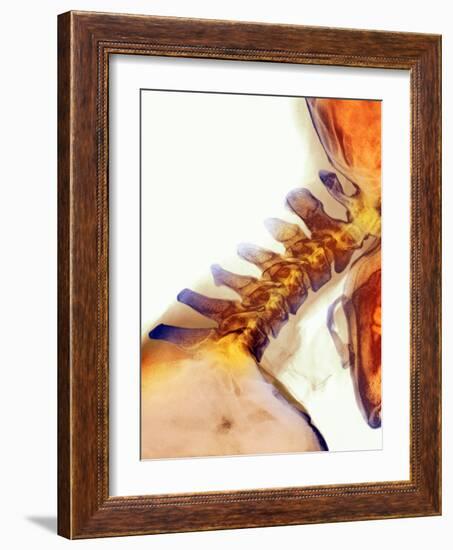 Neck Vertebrae Extended, X-ray-Science Photo Library-Framed Photographic Print