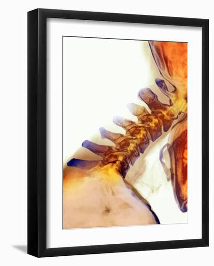 Neck Vertebrae Extended, X-ray-Science Photo Library-Framed Photographic Print