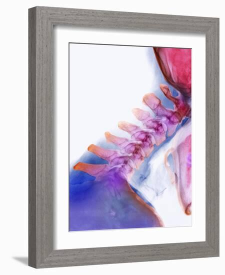 Neck Vertebrae Extended, X-ray-Science Photo Library-Framed Photographic Print