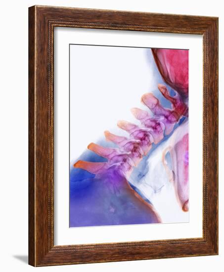 Neck Vertebrae Extended, X-ray-Science Photo Library-Framed Photographic Print