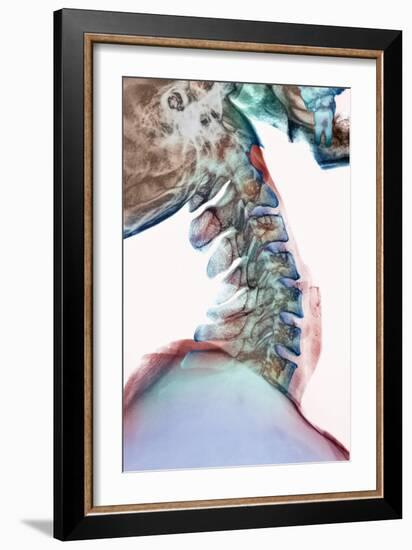 Neck Vertebrae Flexed, X-ray-Science Photo Library-Framed Photographic Print