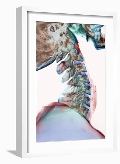 Neck Vertebrae Flexed, X-ray-Science Photo Library-Framed Photographic Print