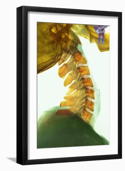 Neck Vertebrae Flexed, X-ray-Science Photo Library-Framed Photographic Print