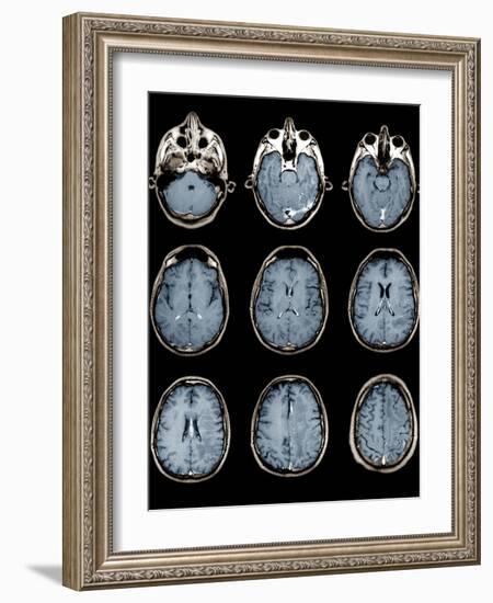 Normal Brain, MRI Scans-ZEPHYR-Framed Photographic Print