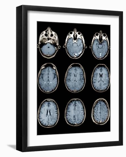 Normal Brain, MRI Scans-ZEPHYR-Framed Photographic Print